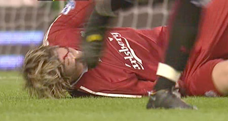 torres-injury Torres - no stranger to the treatment room